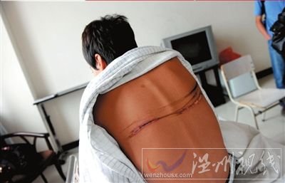 一名傷者背部至今還有明顯的傷疤。