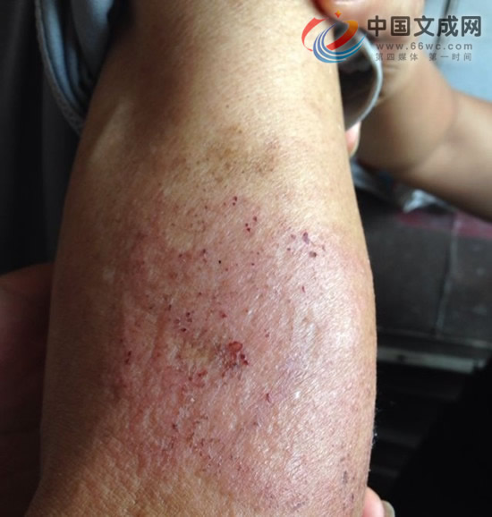 趙欽圖老人被兒媳毒打受傷