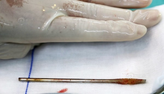 男子鋼釘插尿道后上移到腹部去了 