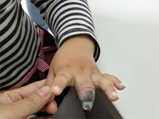4歲女童創可貼使用不當截肢