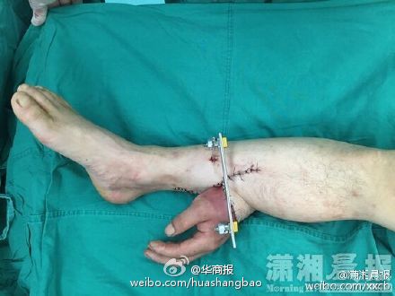 現(xiàn)實(shí)版寄生手掌