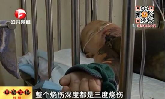男童跌入開(kāi)水盆燙傷