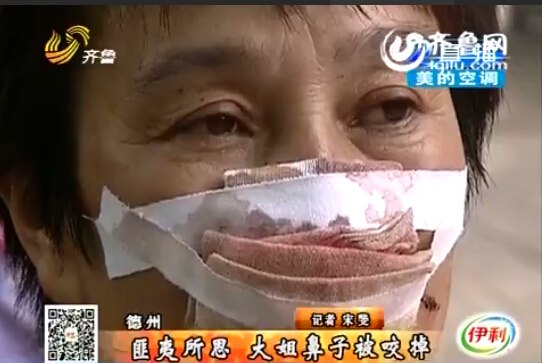 沒接電話鼻子被丈夫咬掉
