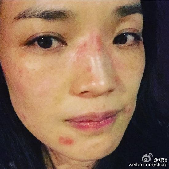 舒淇面部過敏紅腫