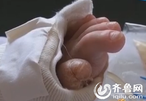 男童連續(xù)高燒8年