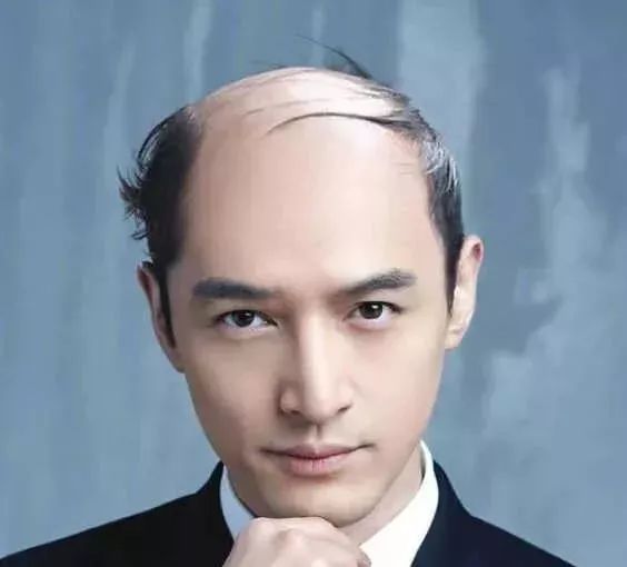脫發(fā)更長(zhǎng)壽上熱搜