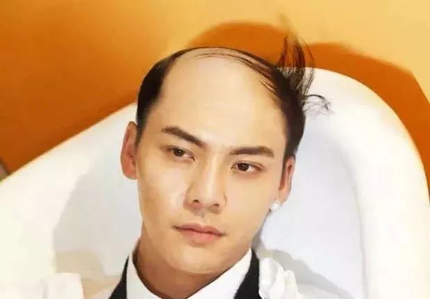 脫發(fā)更長(zhǎng)壽上熱搜