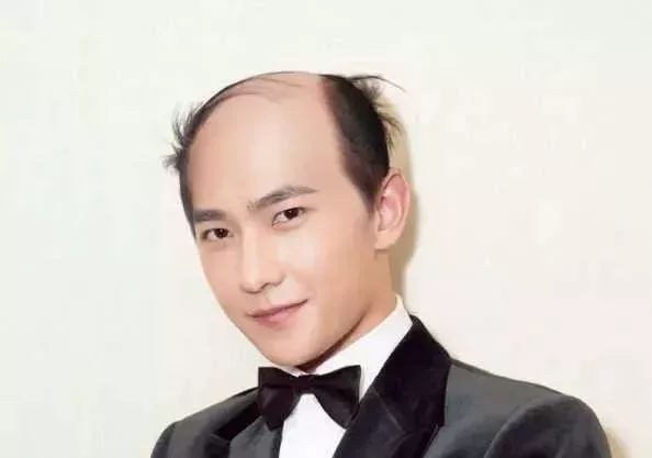 脫發(fā)更長(zhǎng)壽上熱搜