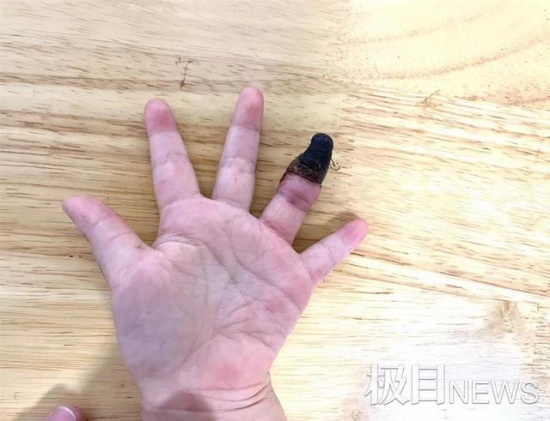 家人錯誤包扎致3歲女童手指壞死